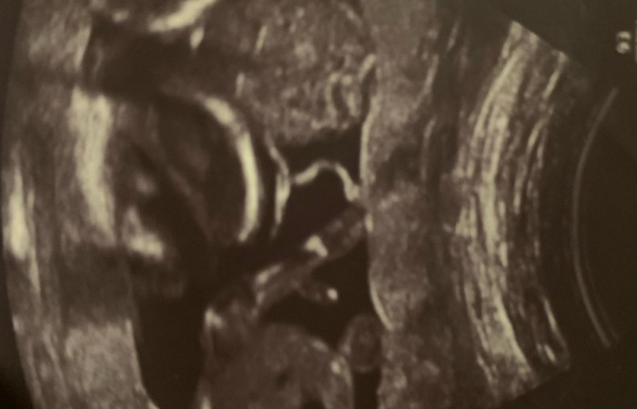 zdjęcie usg czworaczków