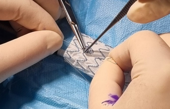 operacja wszczepienia stentgrafu