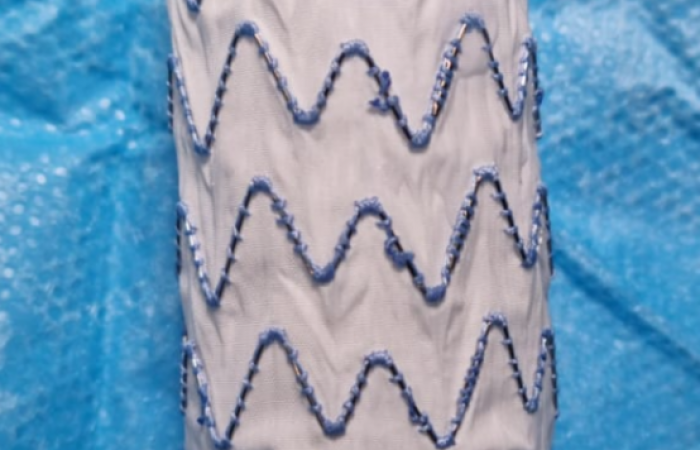 operacja wszczepienia stentgrafu